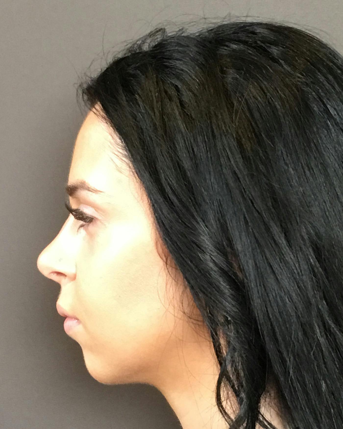 Rhinoplasty Before & After Gallery - Patient 265222 - Image 12