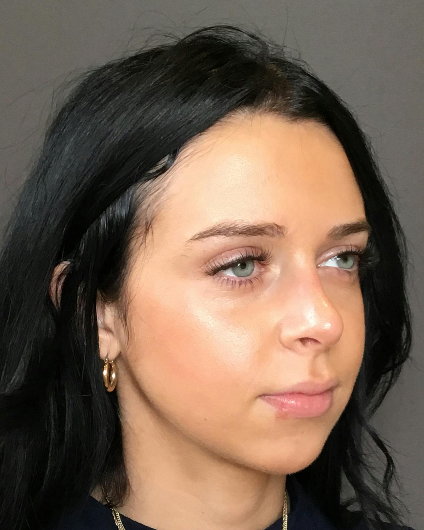 Rhinoplasty Before & After Gallery - Patient 265222 - Image 4