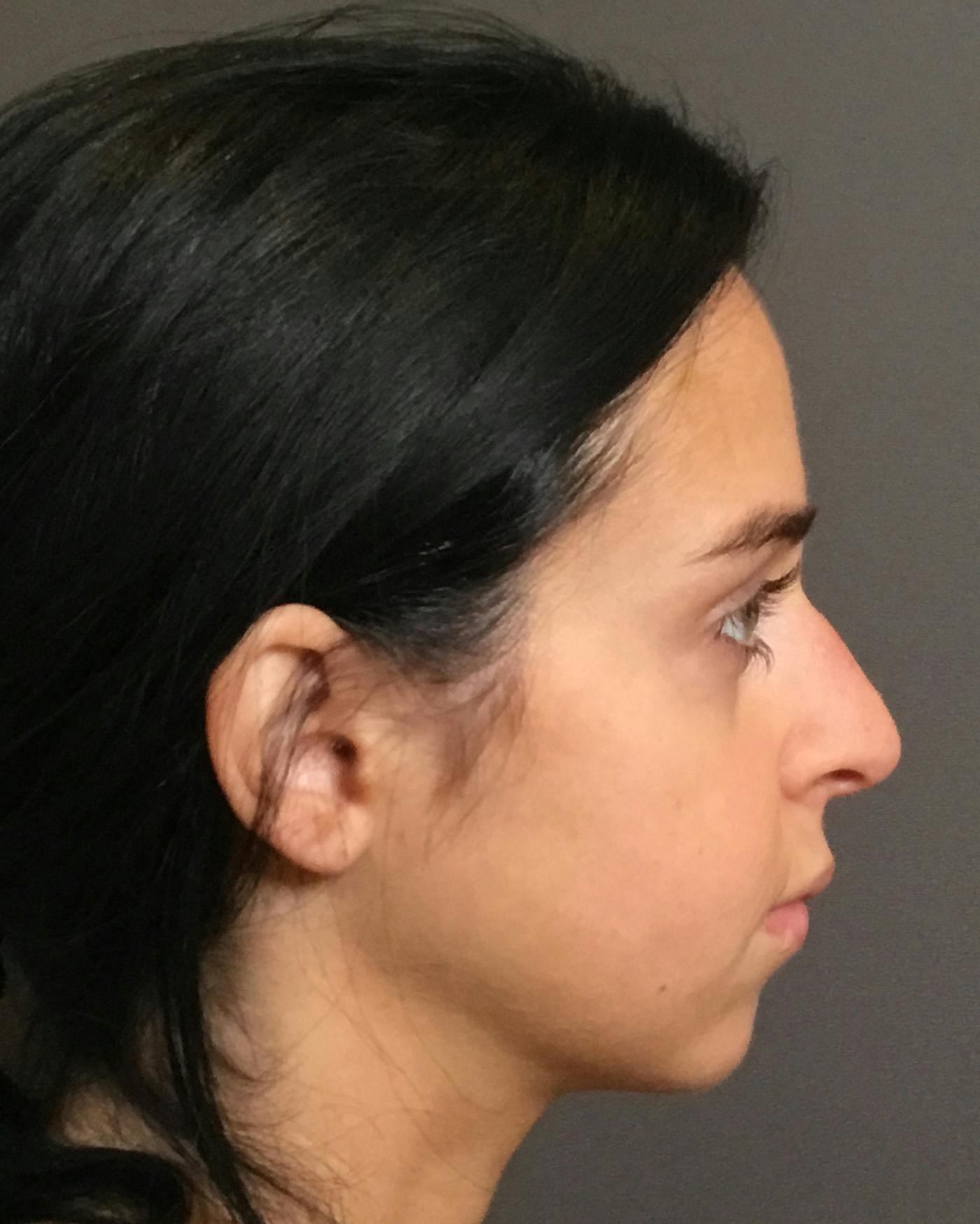 Rhinoplasty Before & After Gallery - Patient 265222 - Image 1