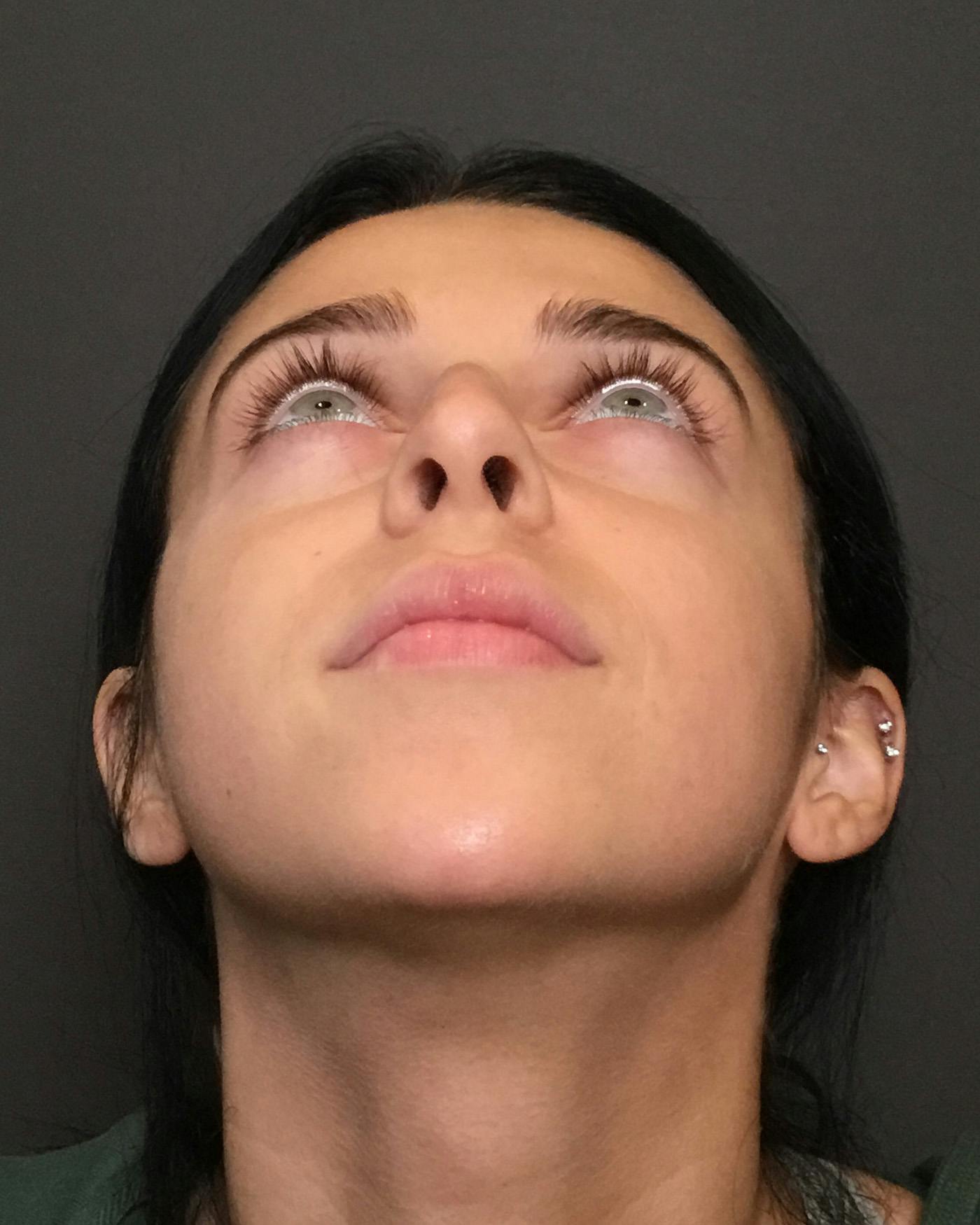 Rhinoplasty Before & After Gallery - Patient 265222 - Image 13