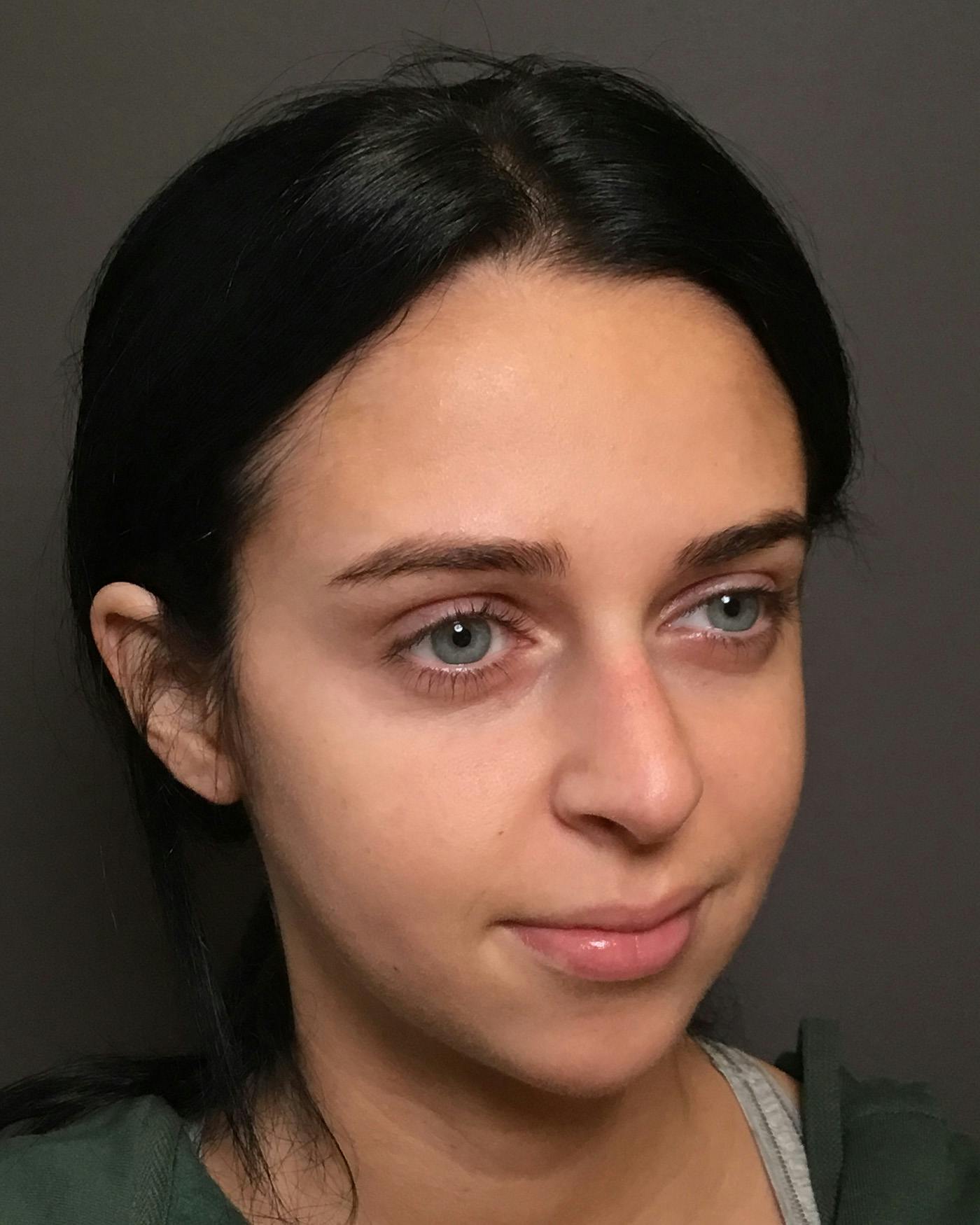 Rhinoplasty Before & After Gallery - Patient 265222 - Image 3