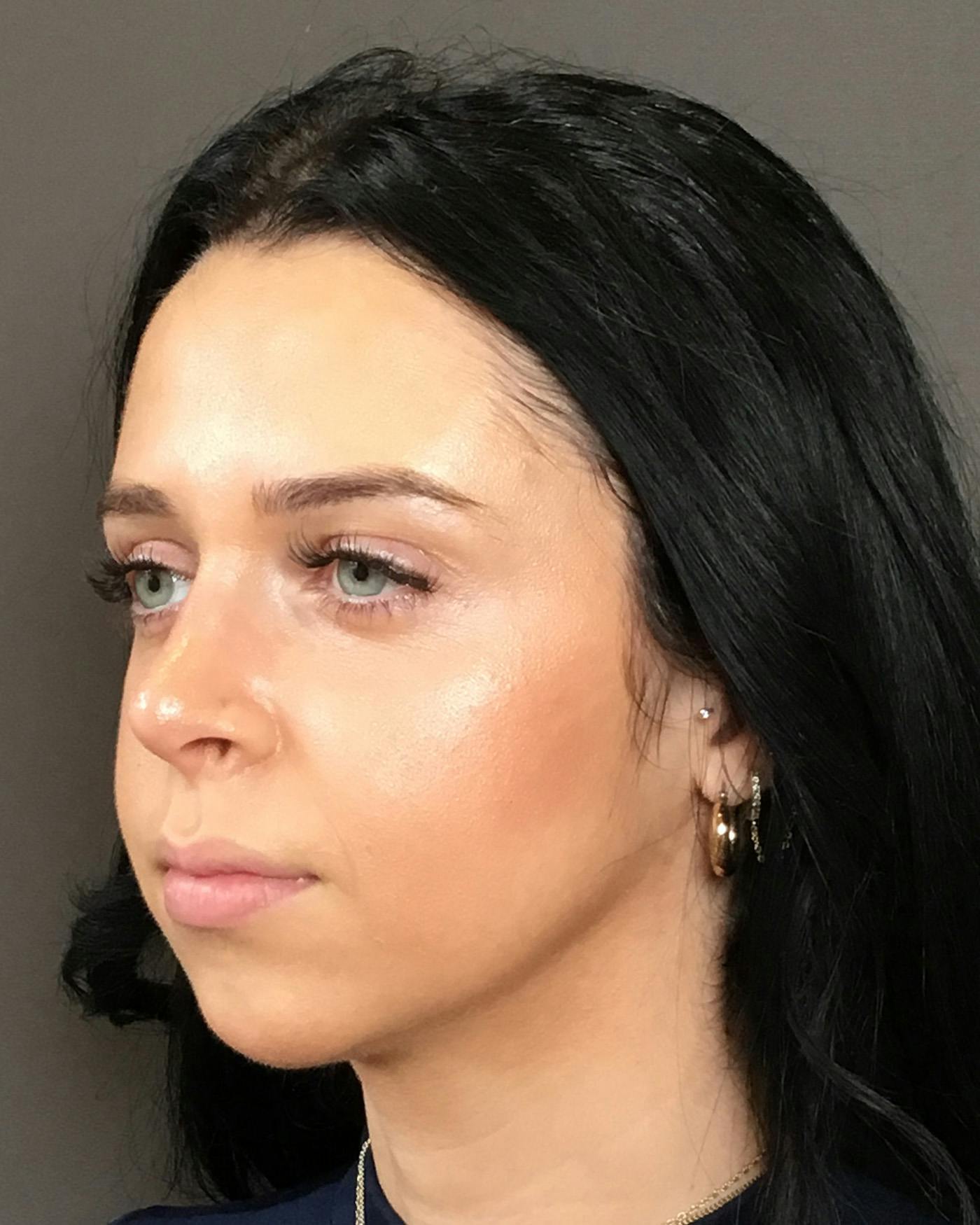 Rhinoplasty Before & After Gallery - Patient 265222 - Image 10