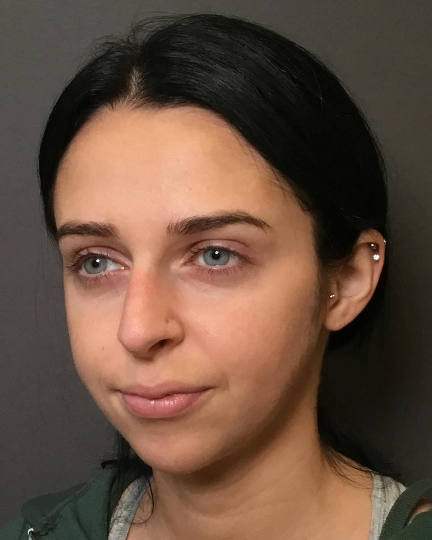 Rhinoplasty Before & After Gallery - Patient 265222 - Image 9