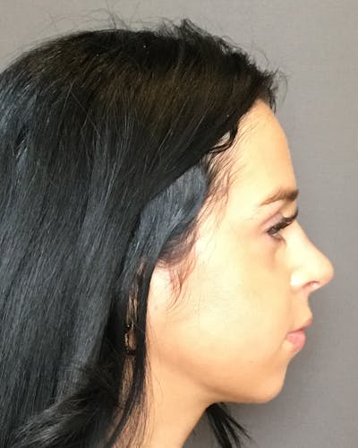 Rhinoplasty Before & After Gallery - Patient 265222 - Image 2