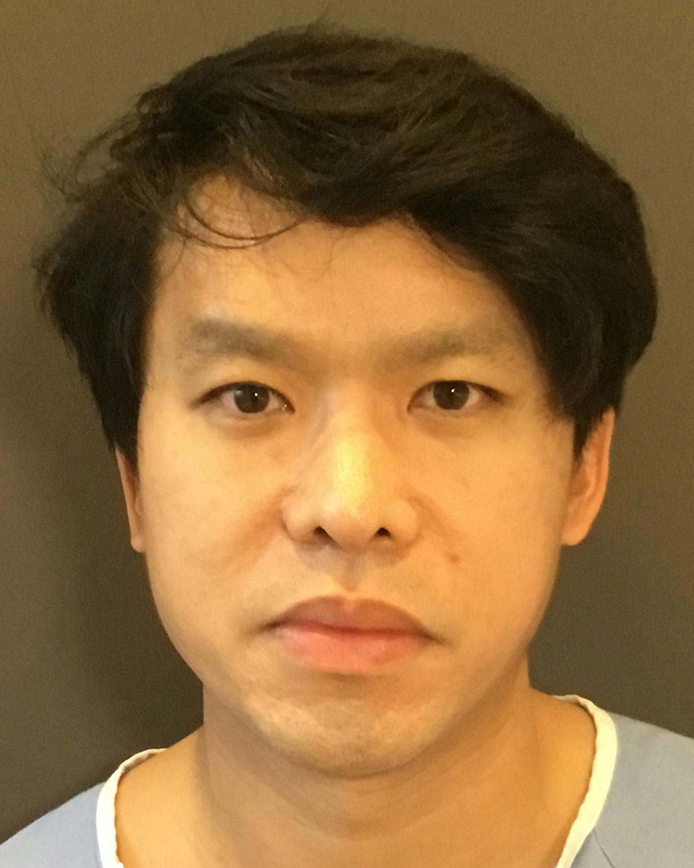Revision Rhinoplasty Before & After Gallery - Patient 536784 - Image 5