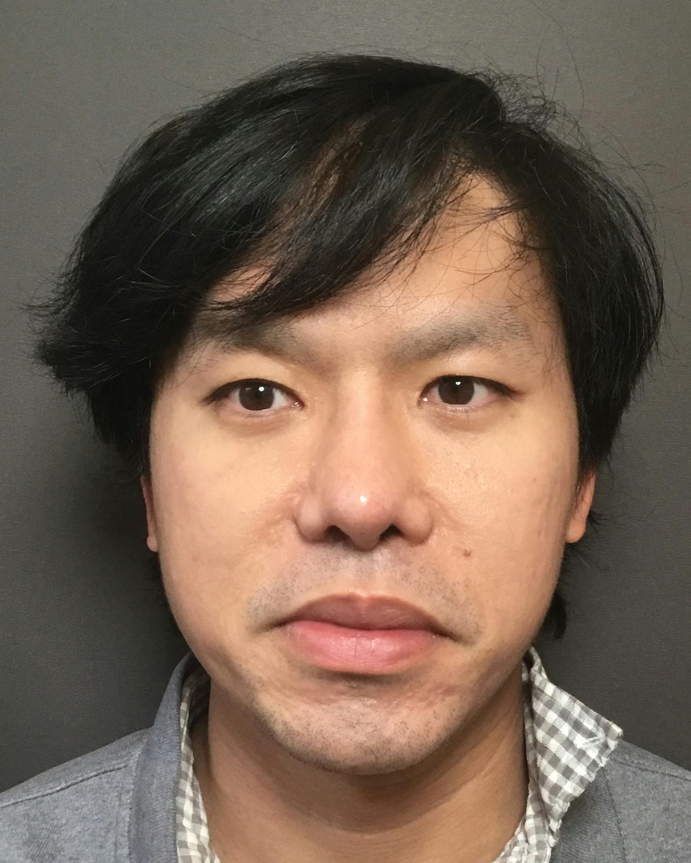 Revision Rhinoplasty Before & After Gallery - Patient 536784 - Image 6
