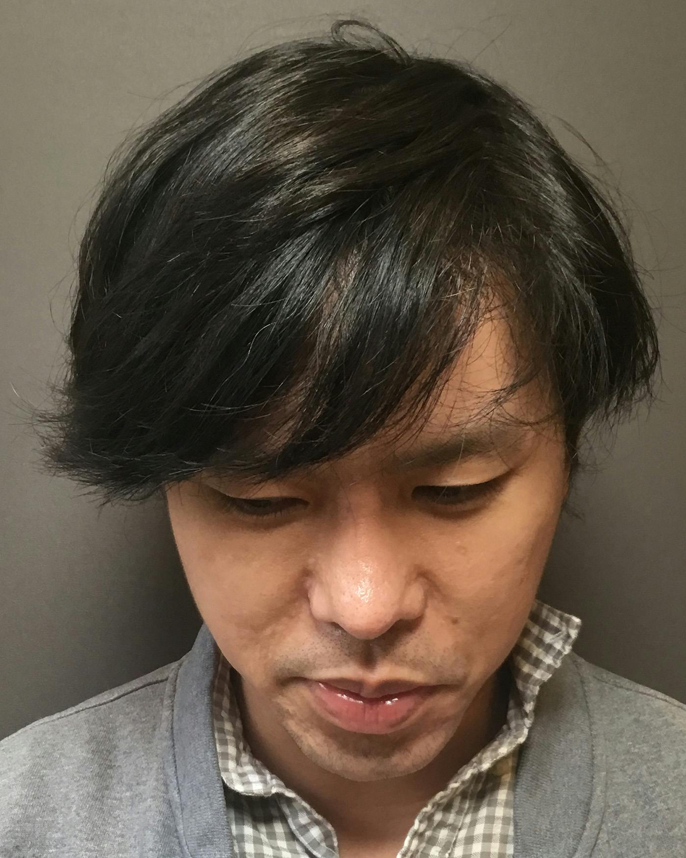 Revision Rhinoplasty Before & After Gallery - Patient 536784 - Image 12
