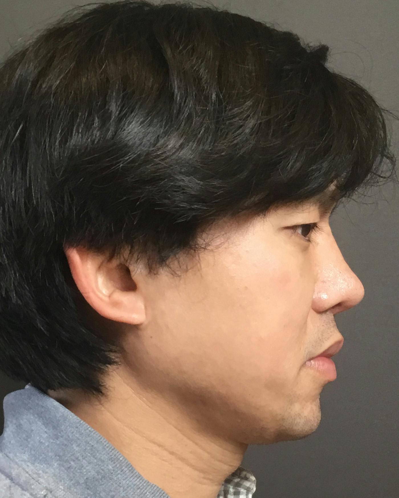 Revision Rhinoplasty Before & After Gallery - Patient 536784 - Image 2