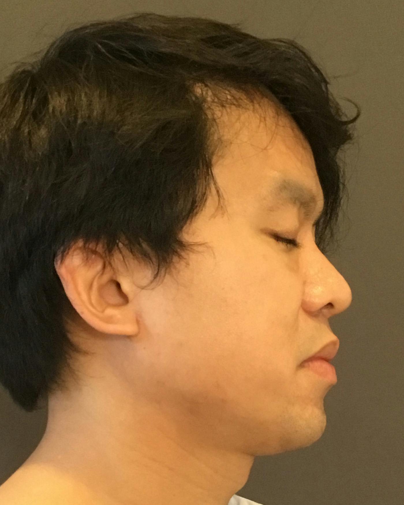 Revision Rhinoplasty Before & After Gallery - Patient 536784 - Image 1