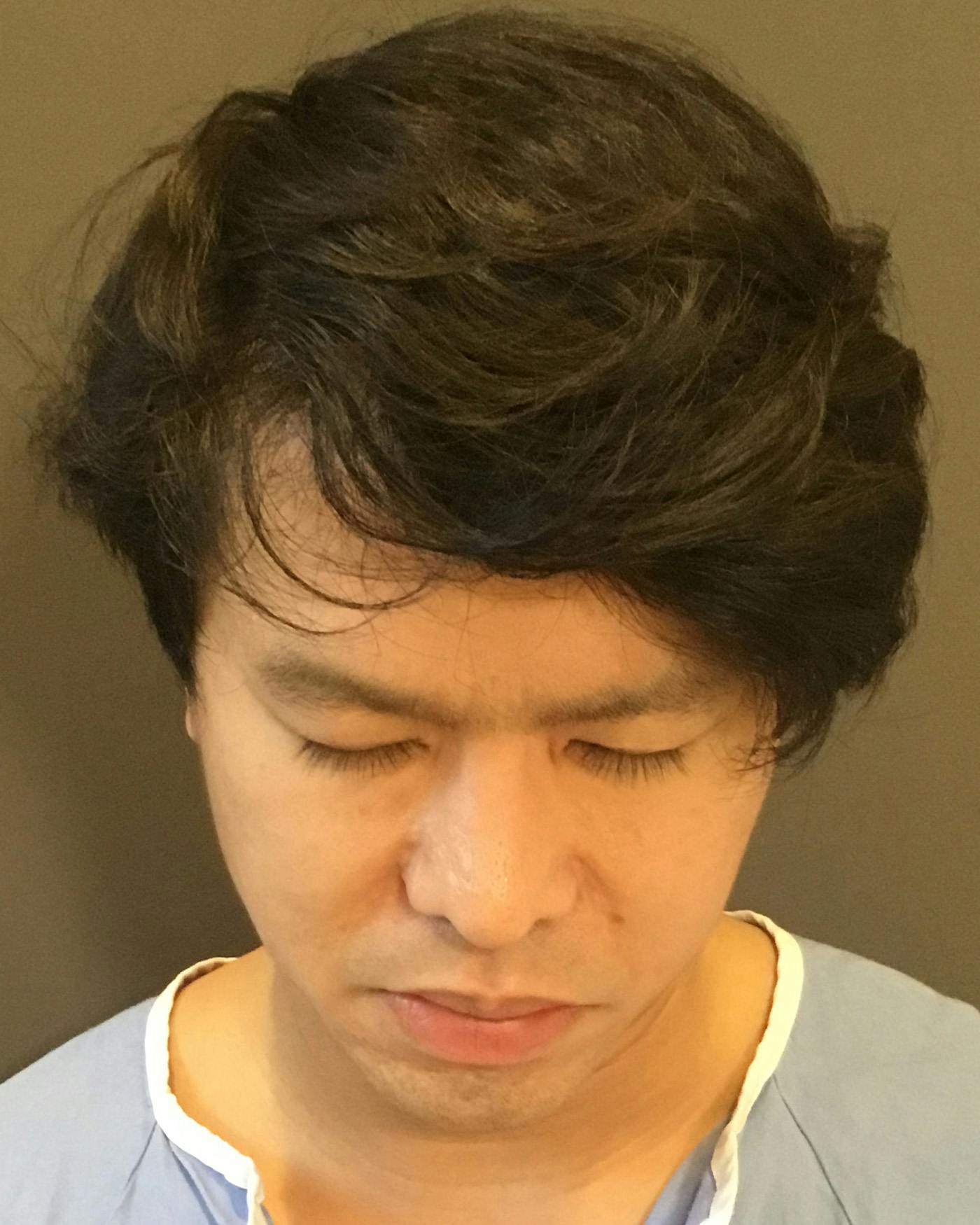Revision Rhinoplasty Before & After Gallery - Patient 536784 - Image 11