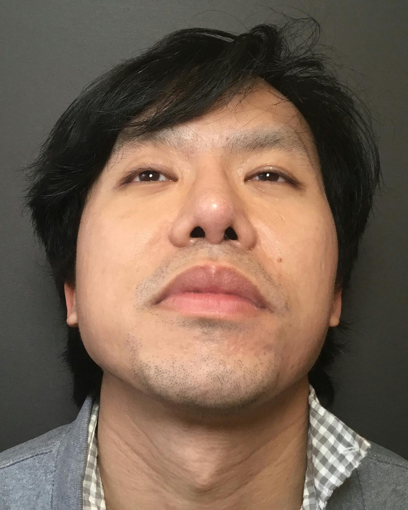 Revision Rhinoplasty Before & After Gallery - Patient 536784 - Image 10