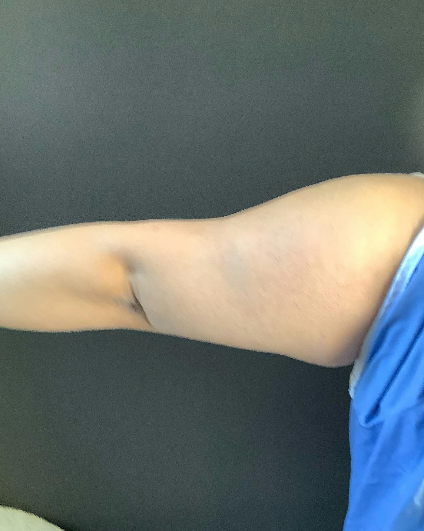 Liposuction Before & After Gallery - Patient 154945 - Image 5