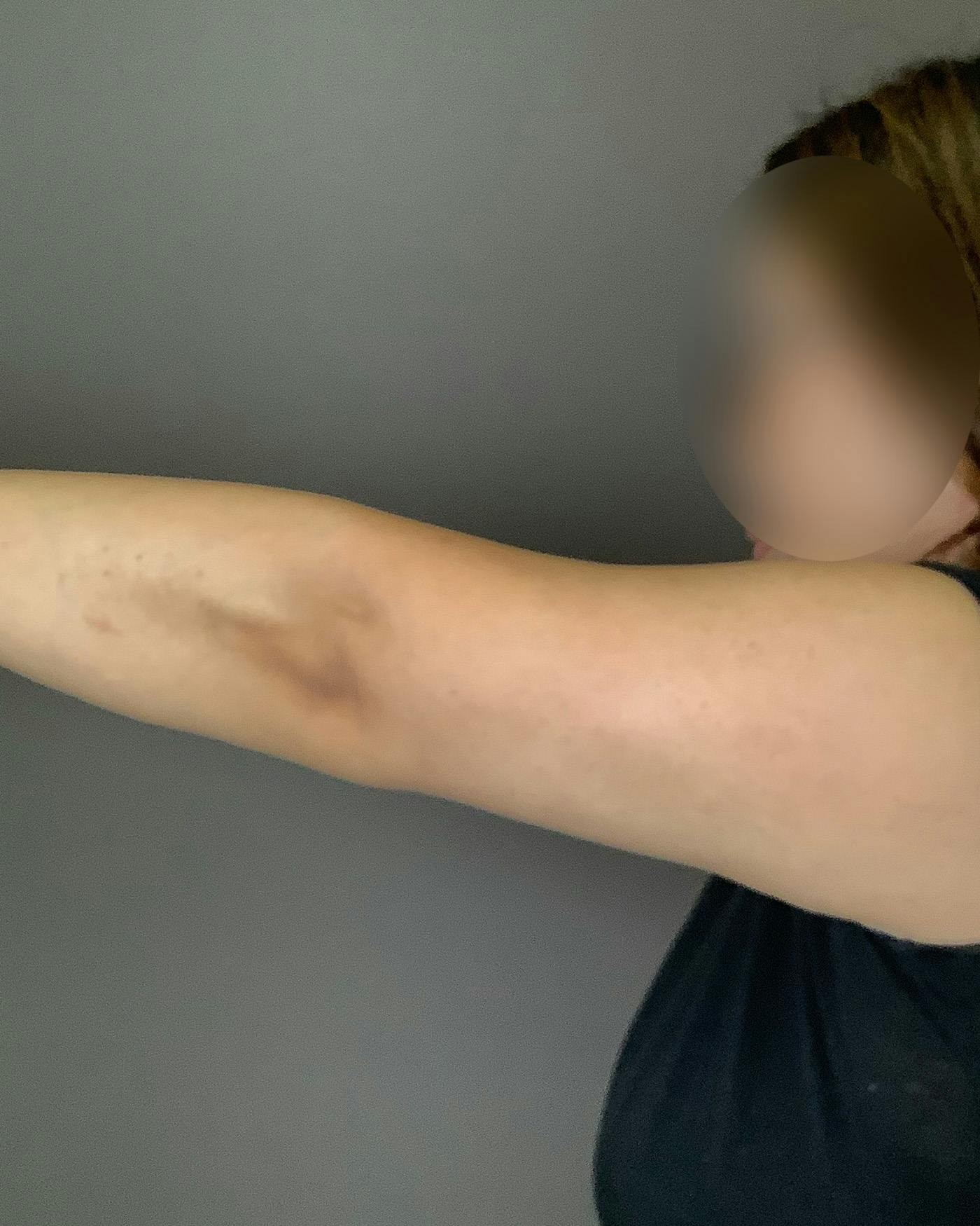 Liposuction Before & After Gallery - Patient 154945 - Image 6