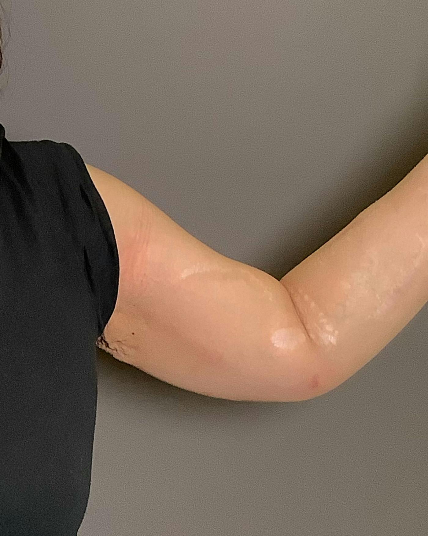 Liposuction Before & After Gallery - Patient 154945 - Image 4