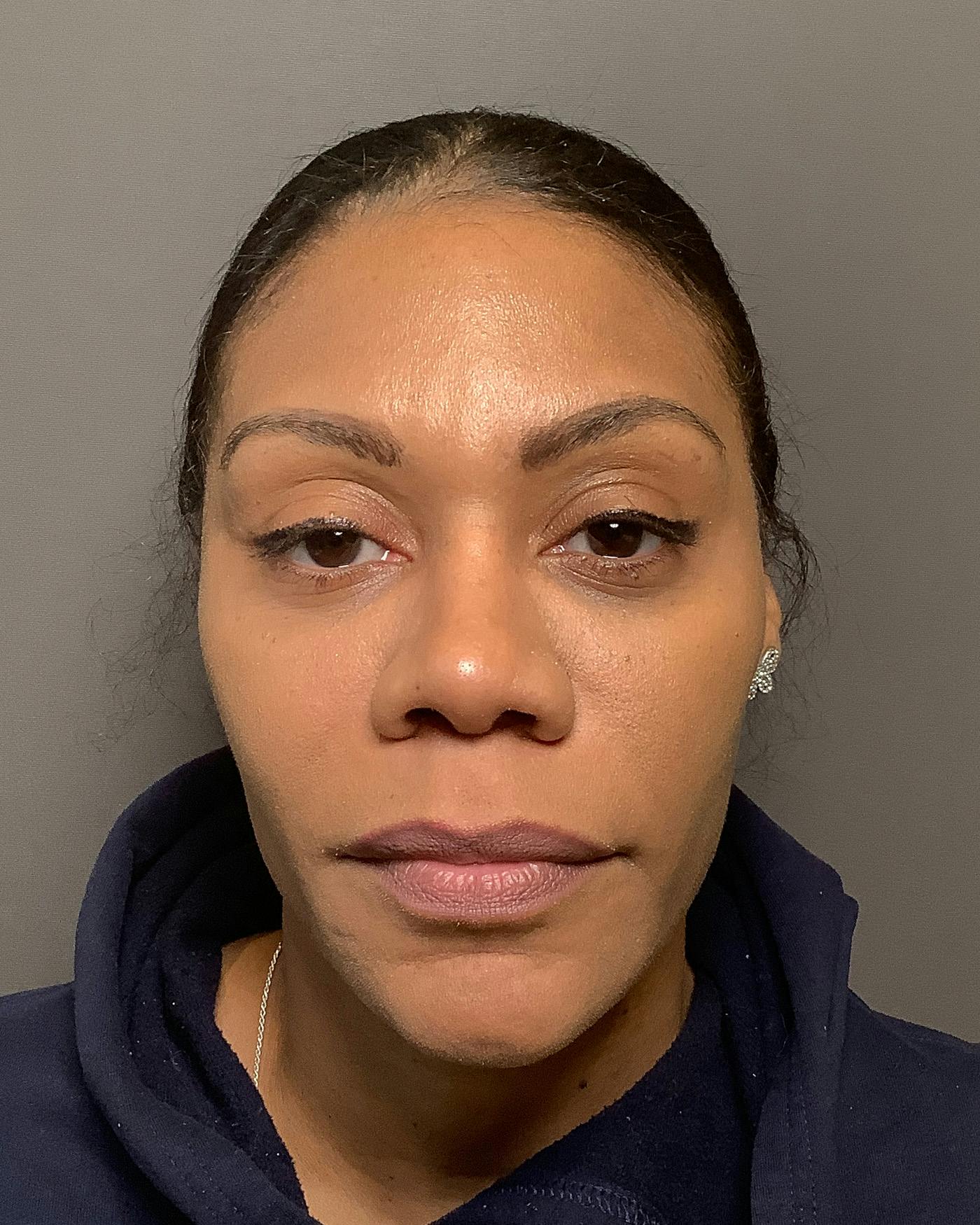 Rhinoplasty Before & After Gallery - Patient 245867 - Image 4