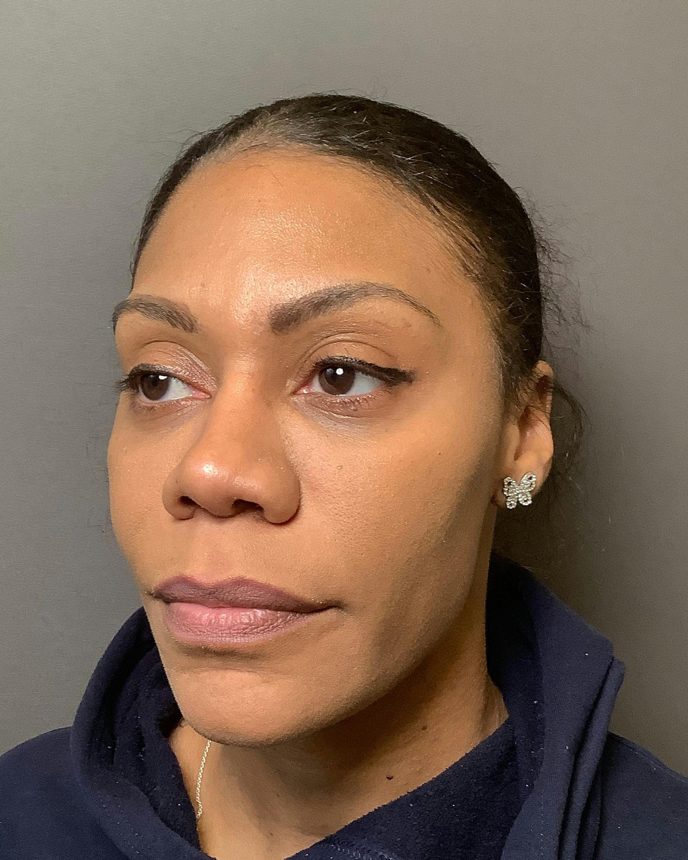 Rhinoplasty Before & After Gallery - Patient 245867 - Image 6