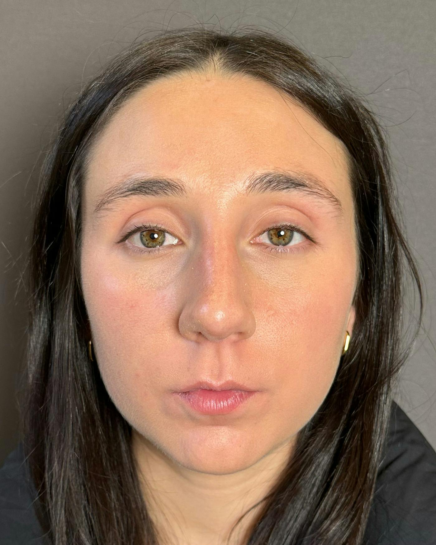 Rhinoplasty Before & After Gallery - Patient 295816 - Image 5