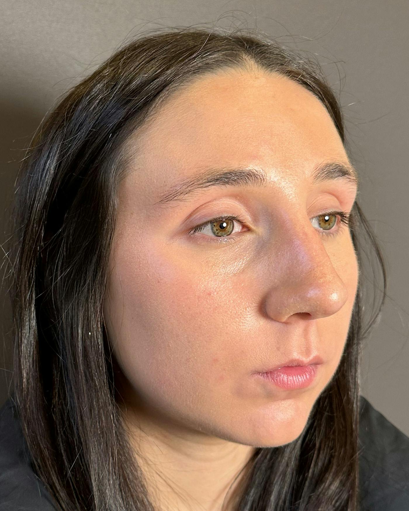 Rhinoplasty Before & After Gallery - Patient 295816 - Image 3