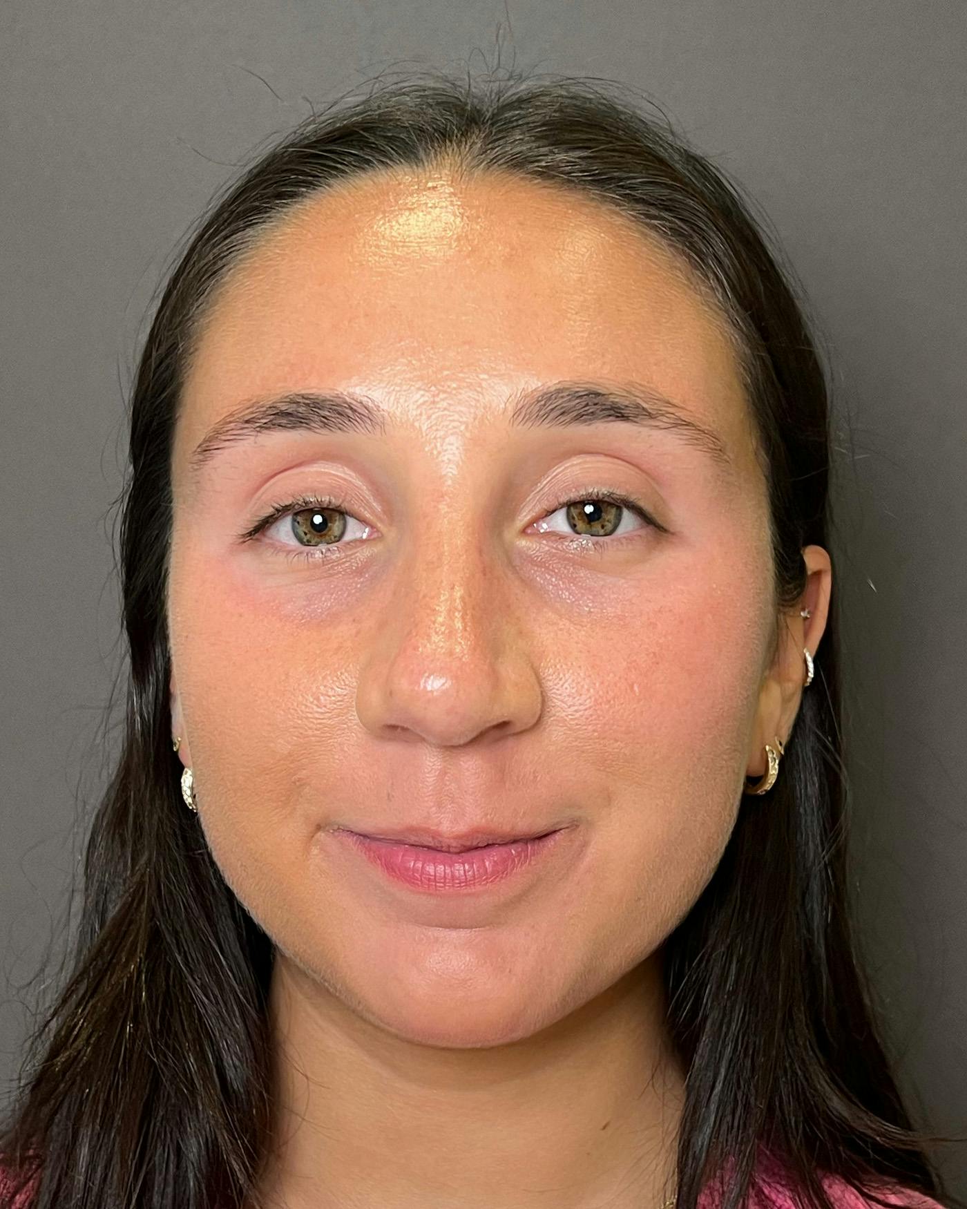 Rhinoplasty Before & After Gallery - Patient 295816 - Image 6