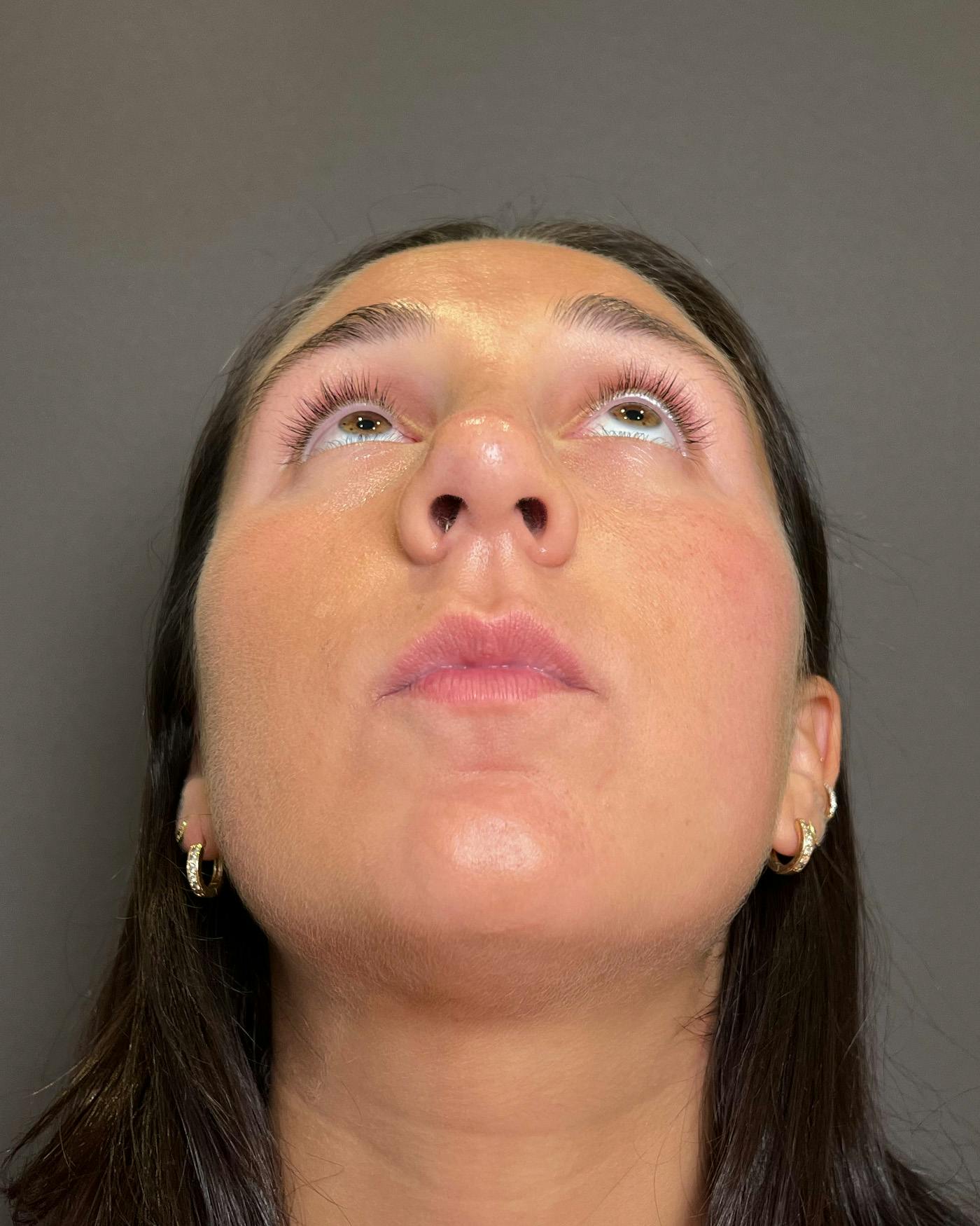 Rhinoplasty Before & After Gallery - Patient 295816 - Image 12