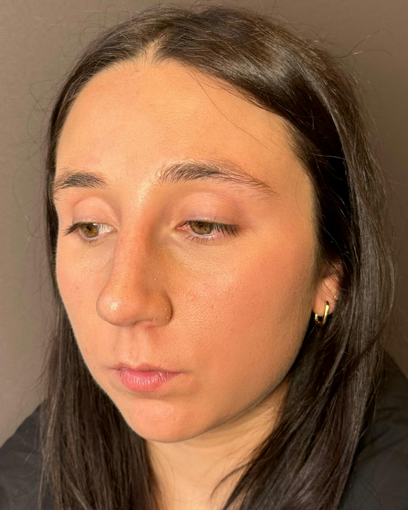 Rhinoplasty Before & After Gallery - Patient 295816 - Image 7