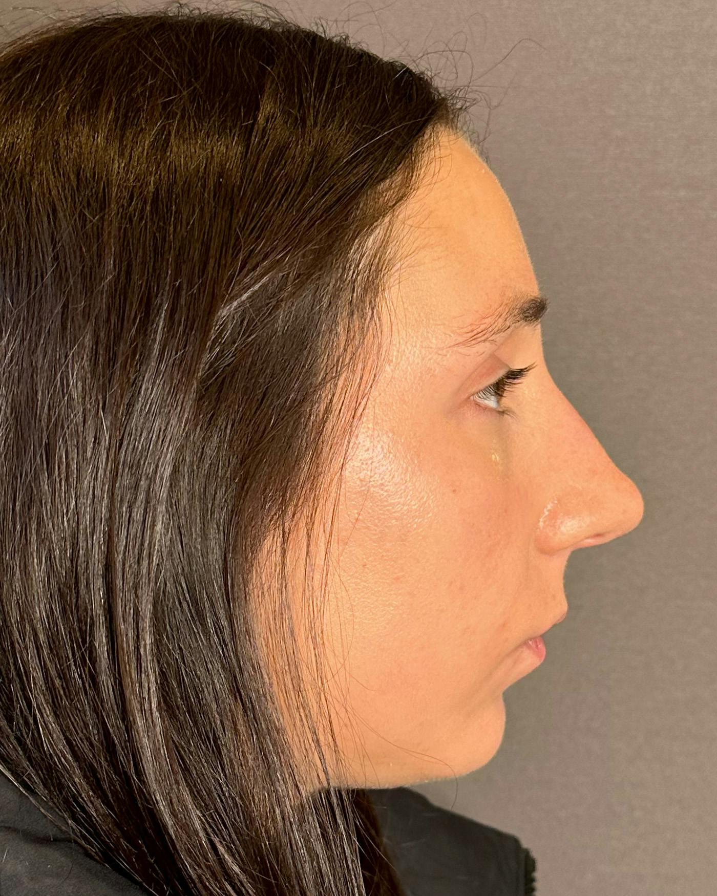 Rhinoplasty Before & After Gallery - Patient 295816 - Image 1