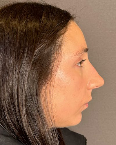 Rhinoplasty Before & After Gallery - Patient 295816 - Image 1