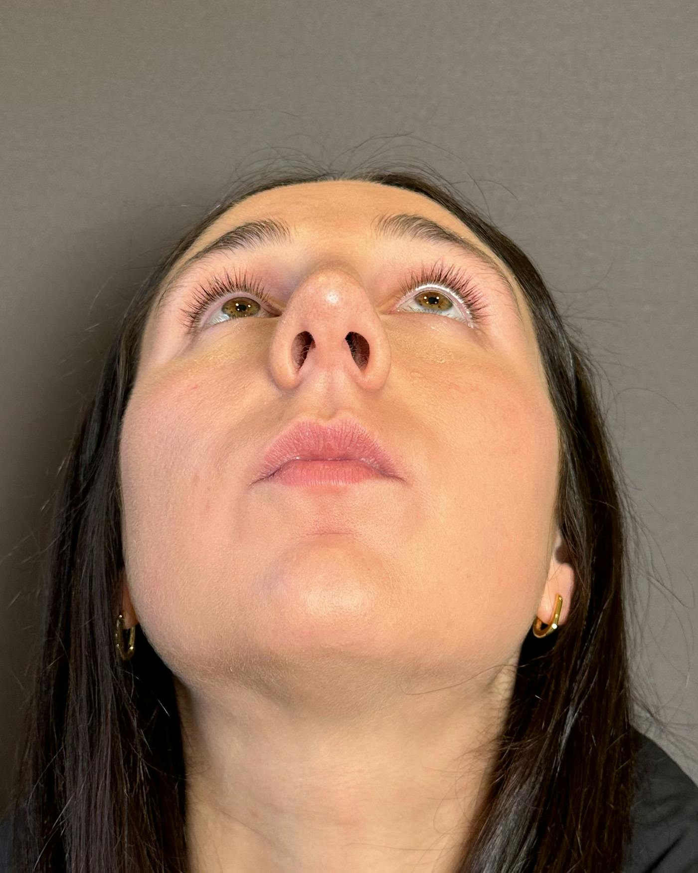 Rhinoplasty Before & After Gallery - Patient 295816 - Image 11