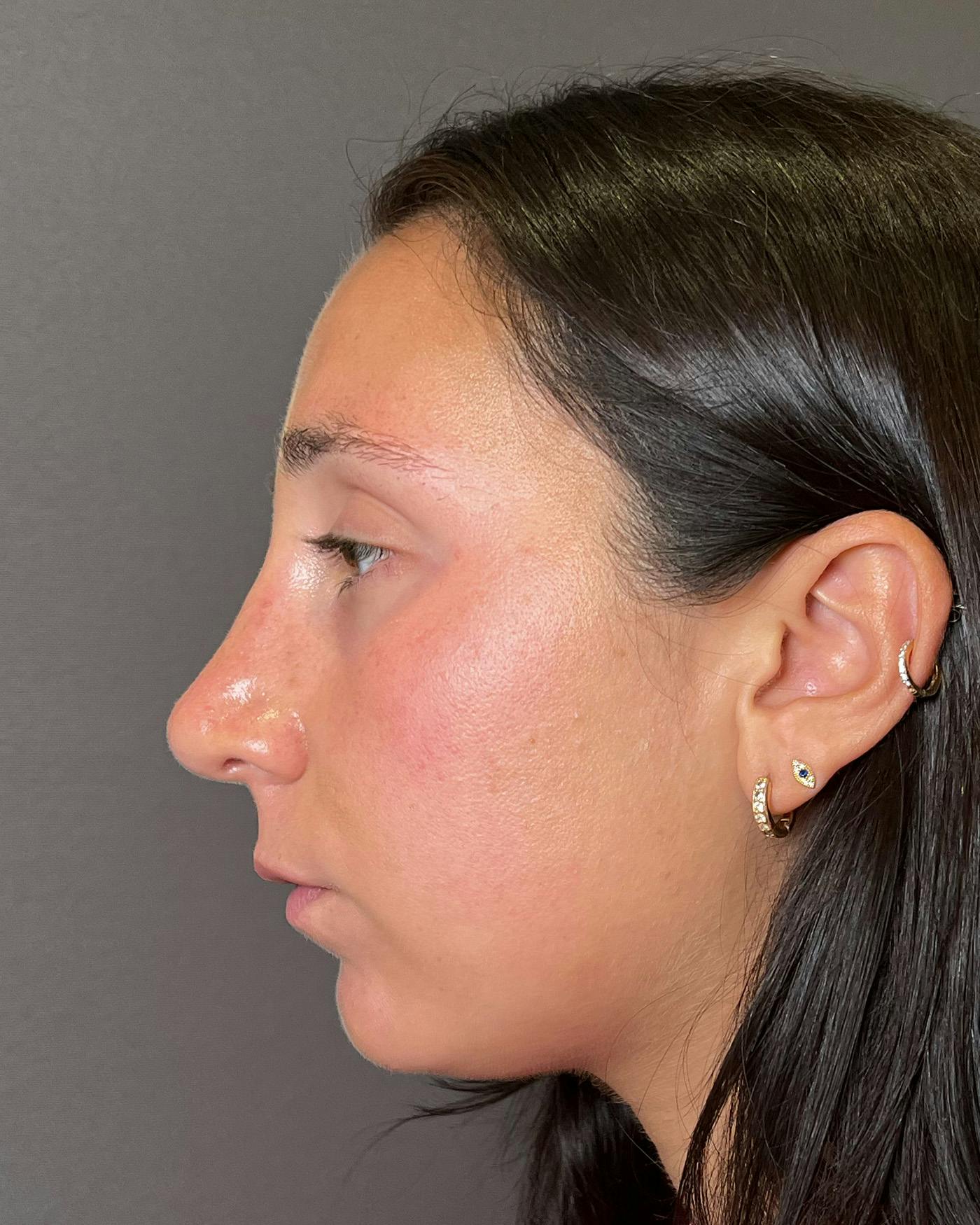 Rhinoplasty Before & After Gallery - Patient 295816 - Image 10