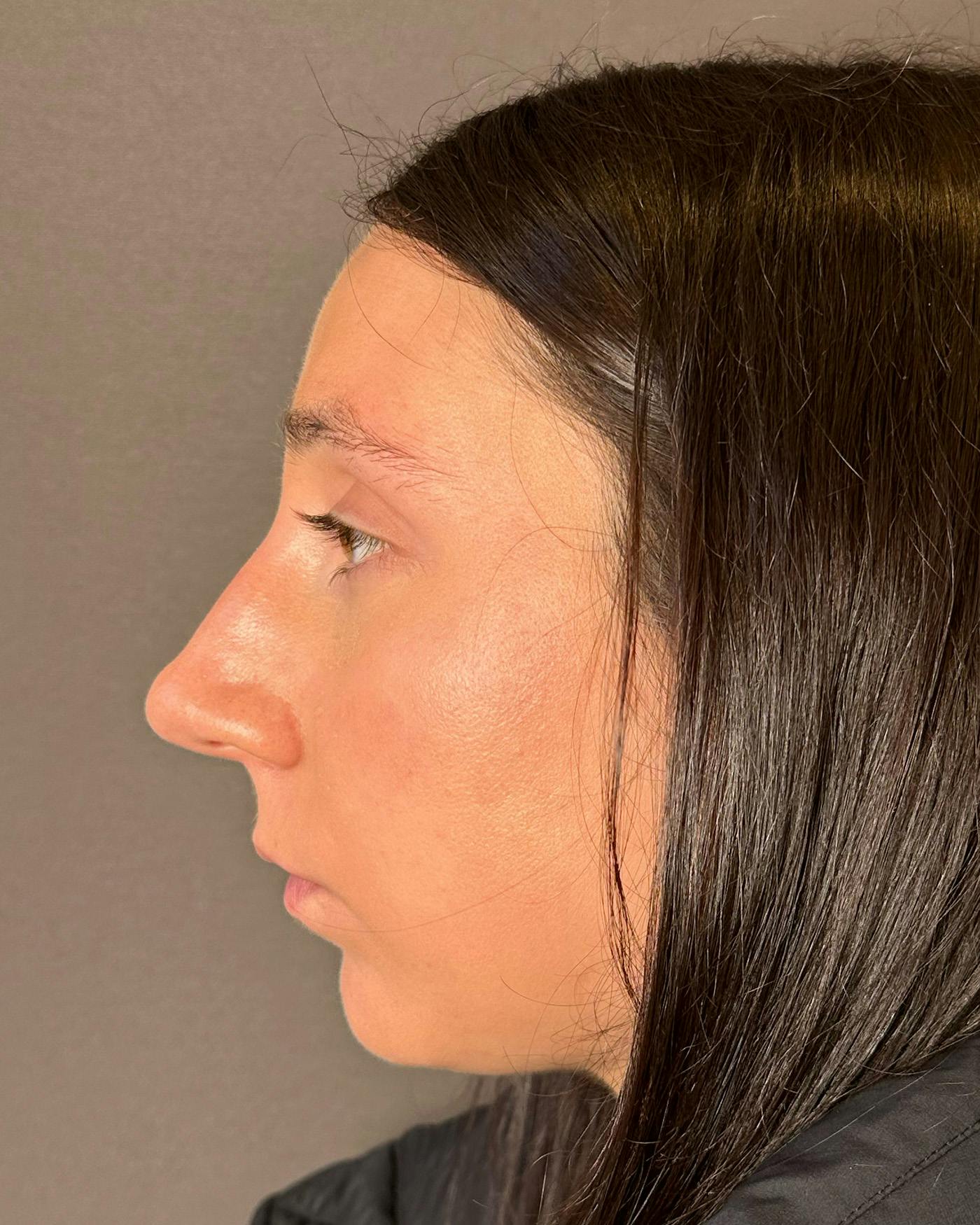 Rhinoplasty Before & After Gallery - Patient 295816 - Image 9