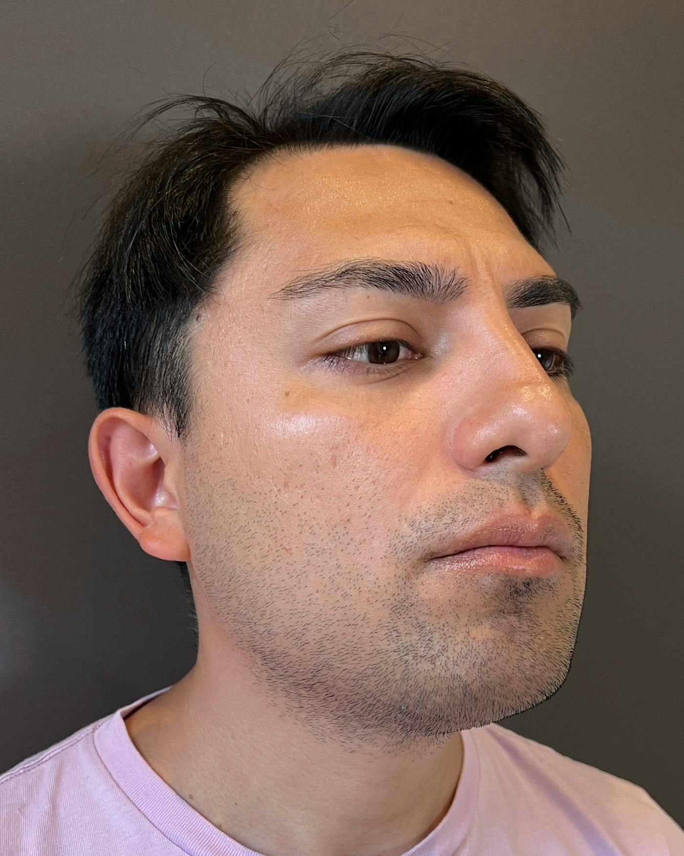 Liposuction Before & After Gallery - Patient 375667 - Image 3