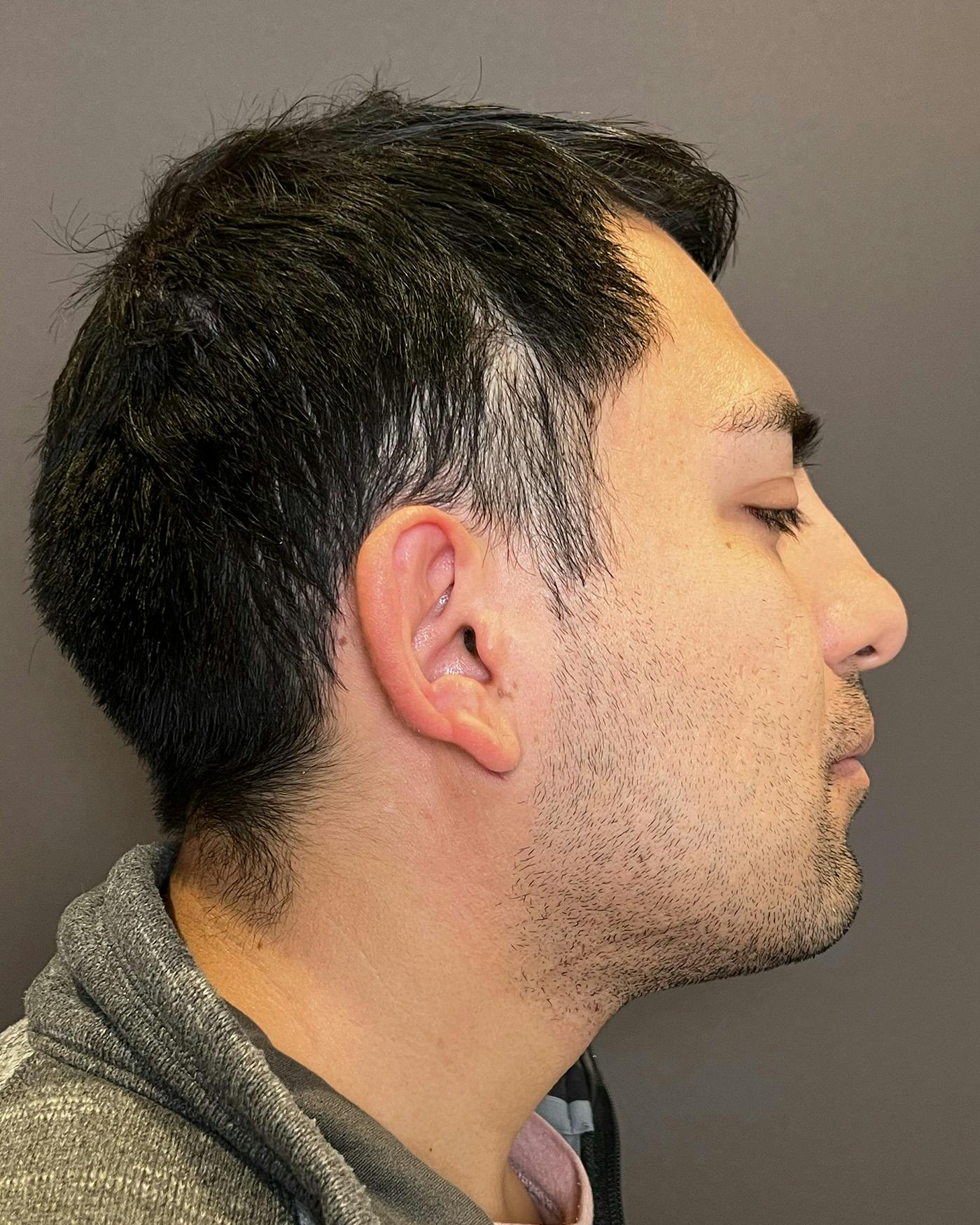 Liposuction Before & After Gallery - Patient 375667 - Image 6
