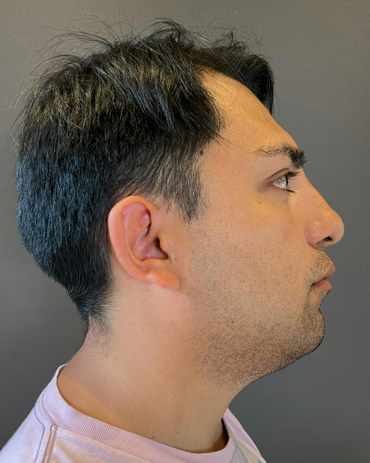 Liposuction Before & After Gallery - Patient 375667 - Image 5