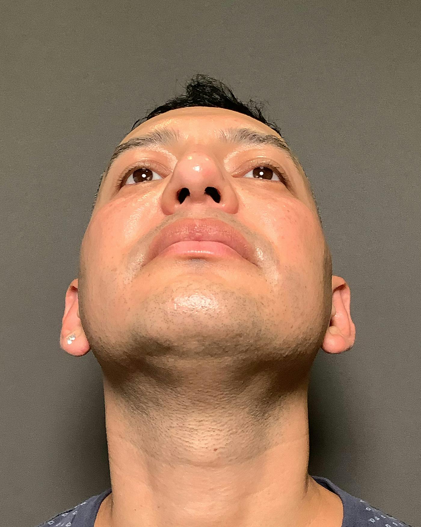 Rhinoplasty Before & After Gallery - Patient 748574 - Image 12