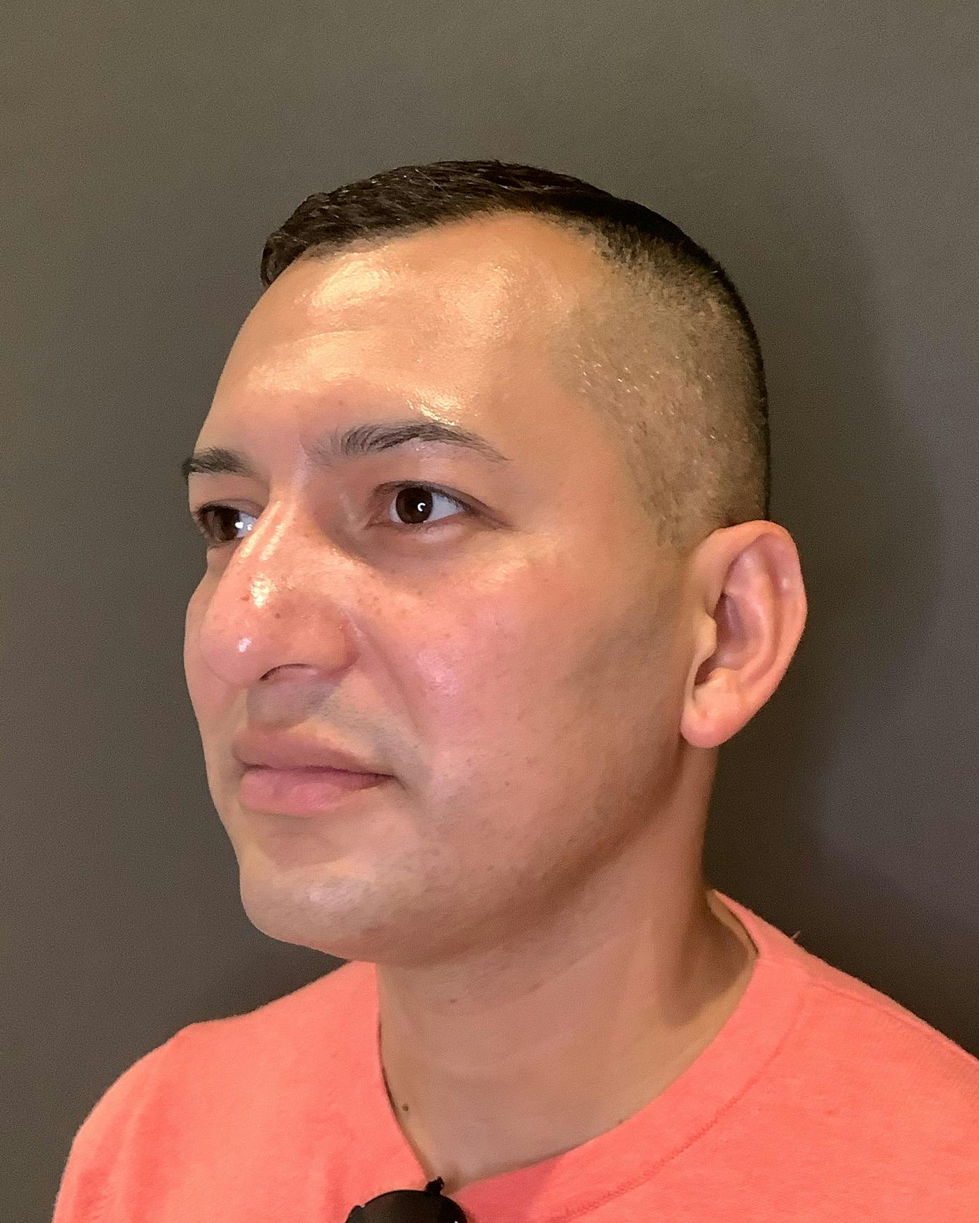 Rhinoplasty Before & After Gallery - Patient 748574 - Image 7