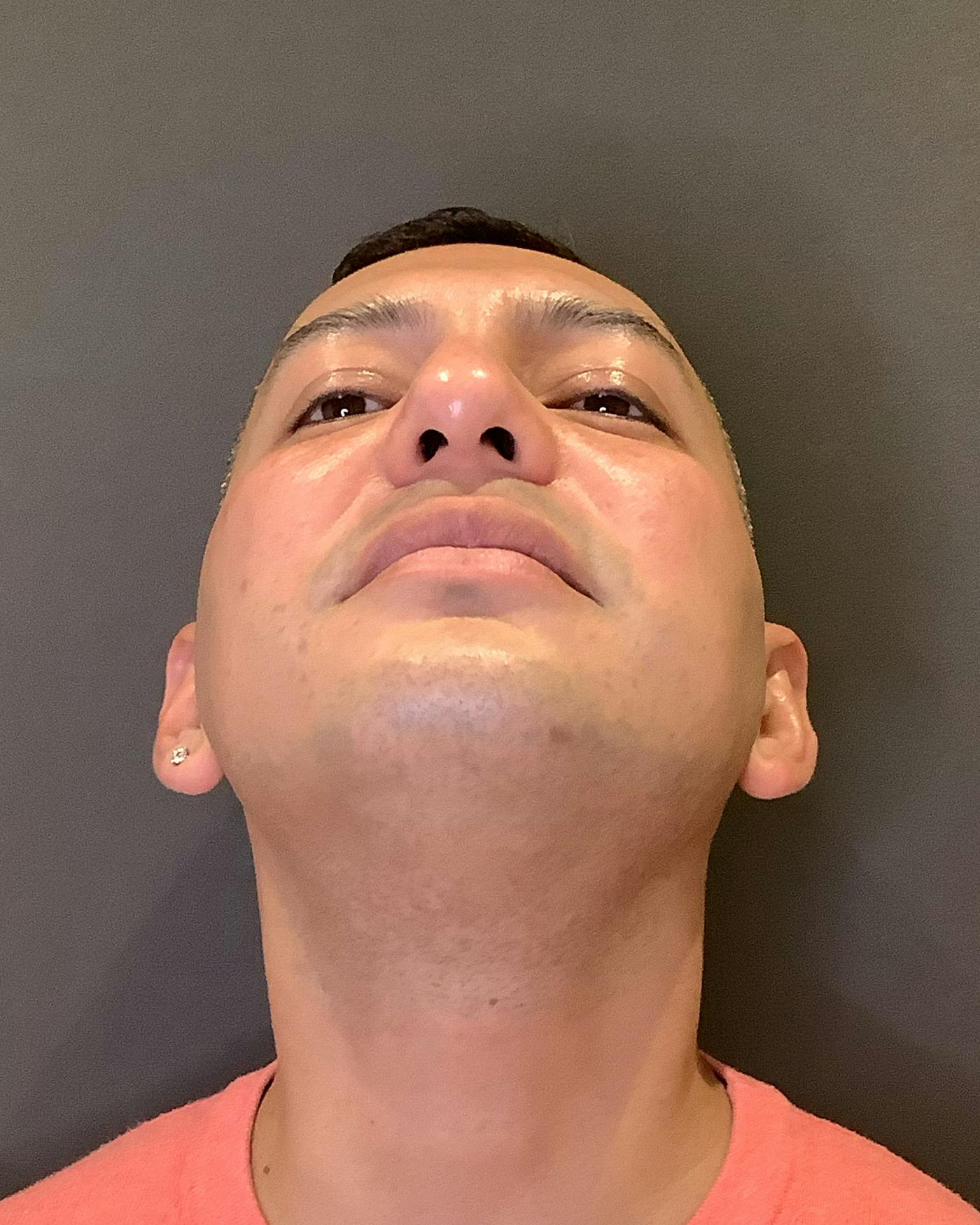 Rhinoplasty Before & After Gallery - Patient 748574 - Image 11
