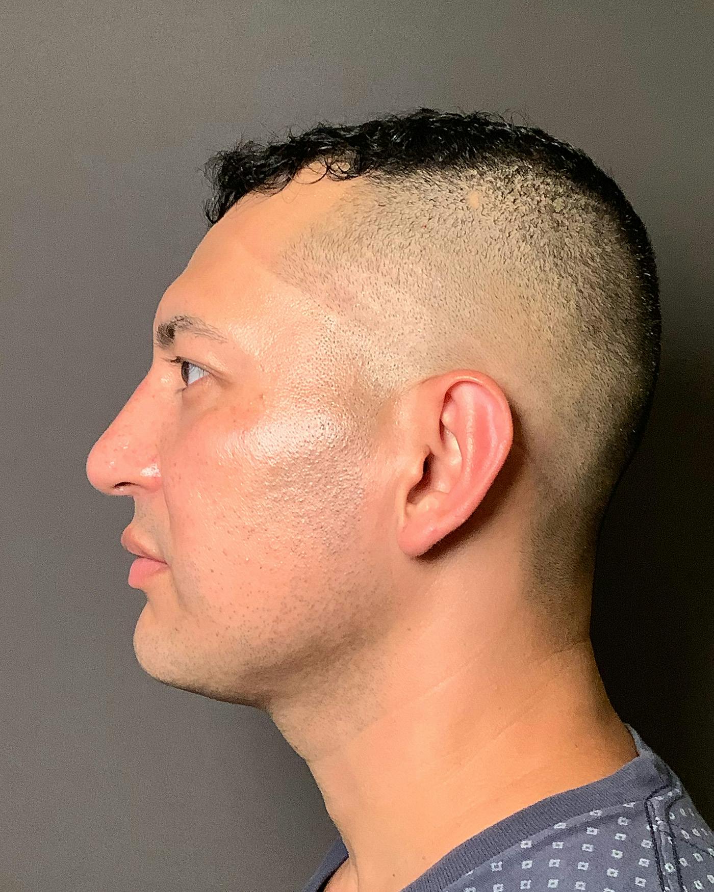 Rhinoplasty Before & After Gallery - Patient 748574 - Image 10