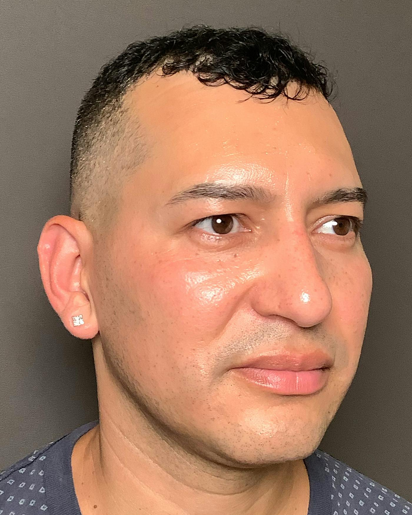 Rhinoplasty Before & After Gallery - Patient 748574 - Image 4