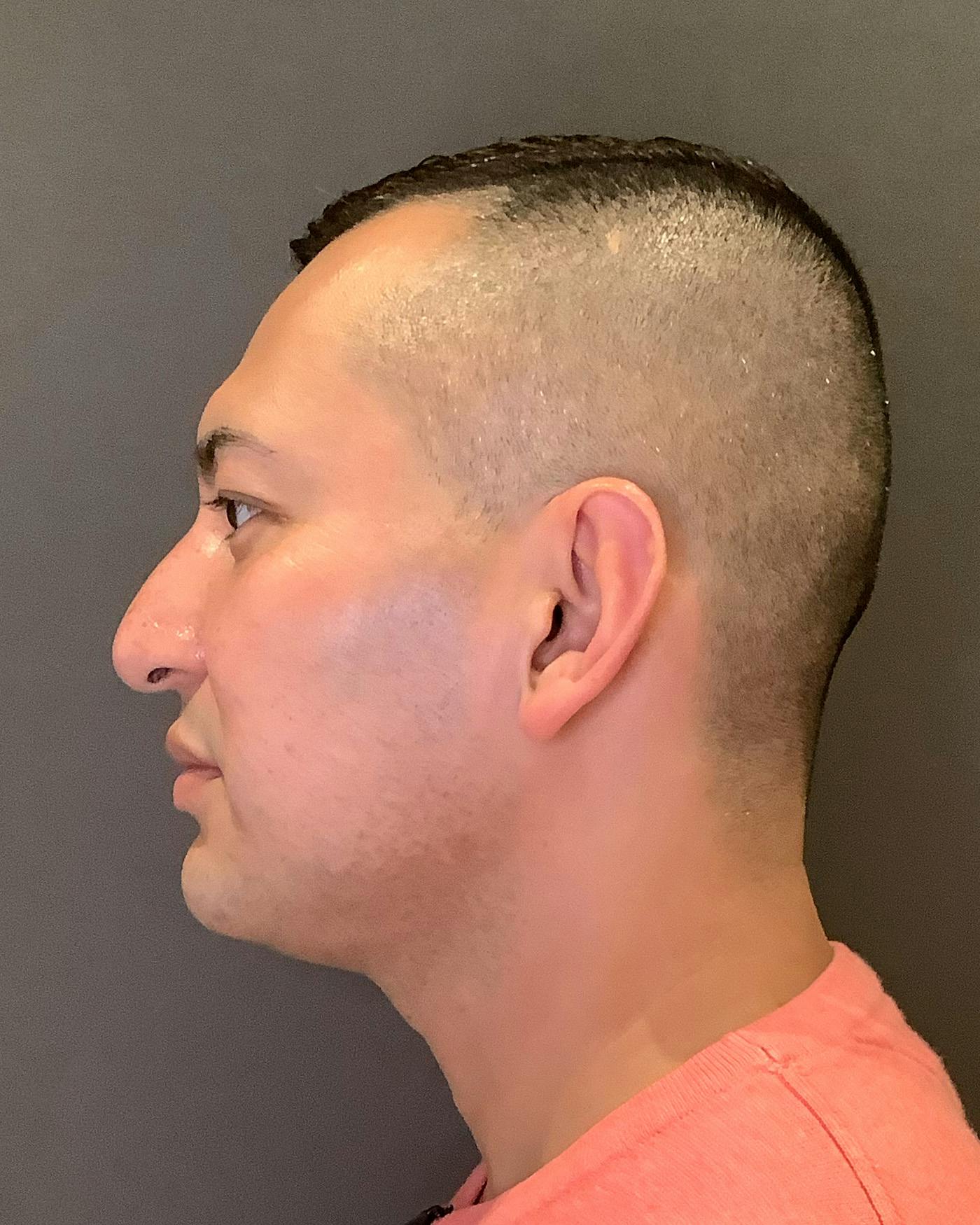 Rhinoplasty Before & After Gallery - Patient 748574 - Image 9