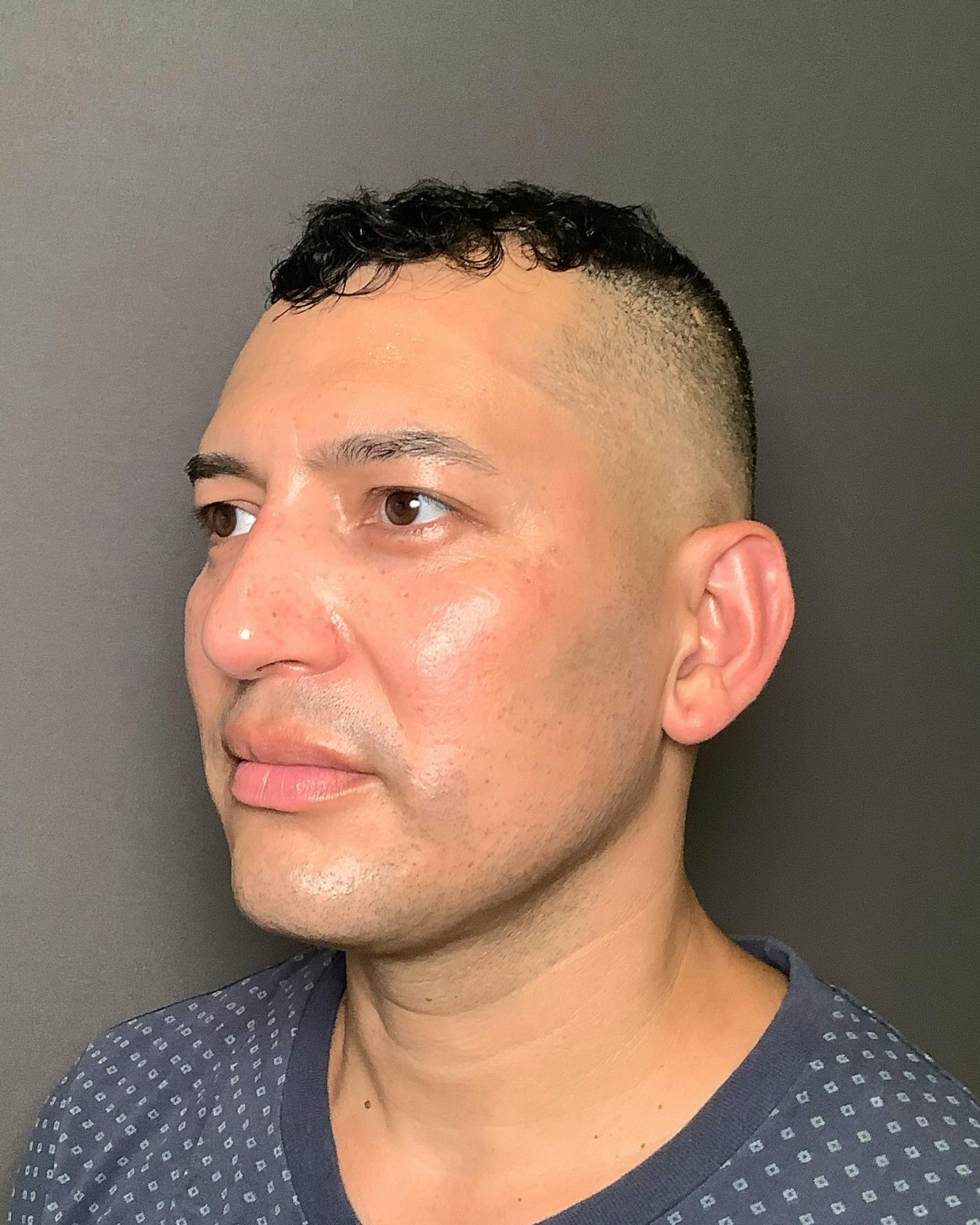 Rhinoplasty Before & After Gallery - Patient 748574 - Image 8