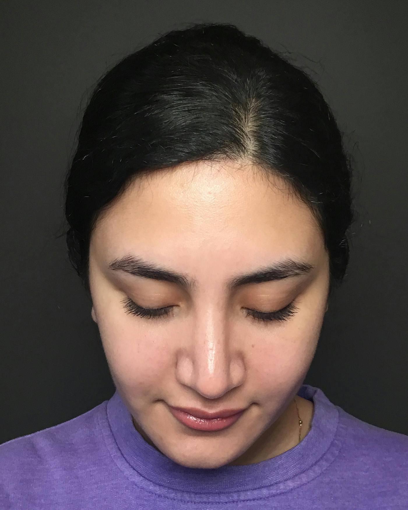 Rhinoplasty Before & After Gallery - Patient 403059 - Image 14