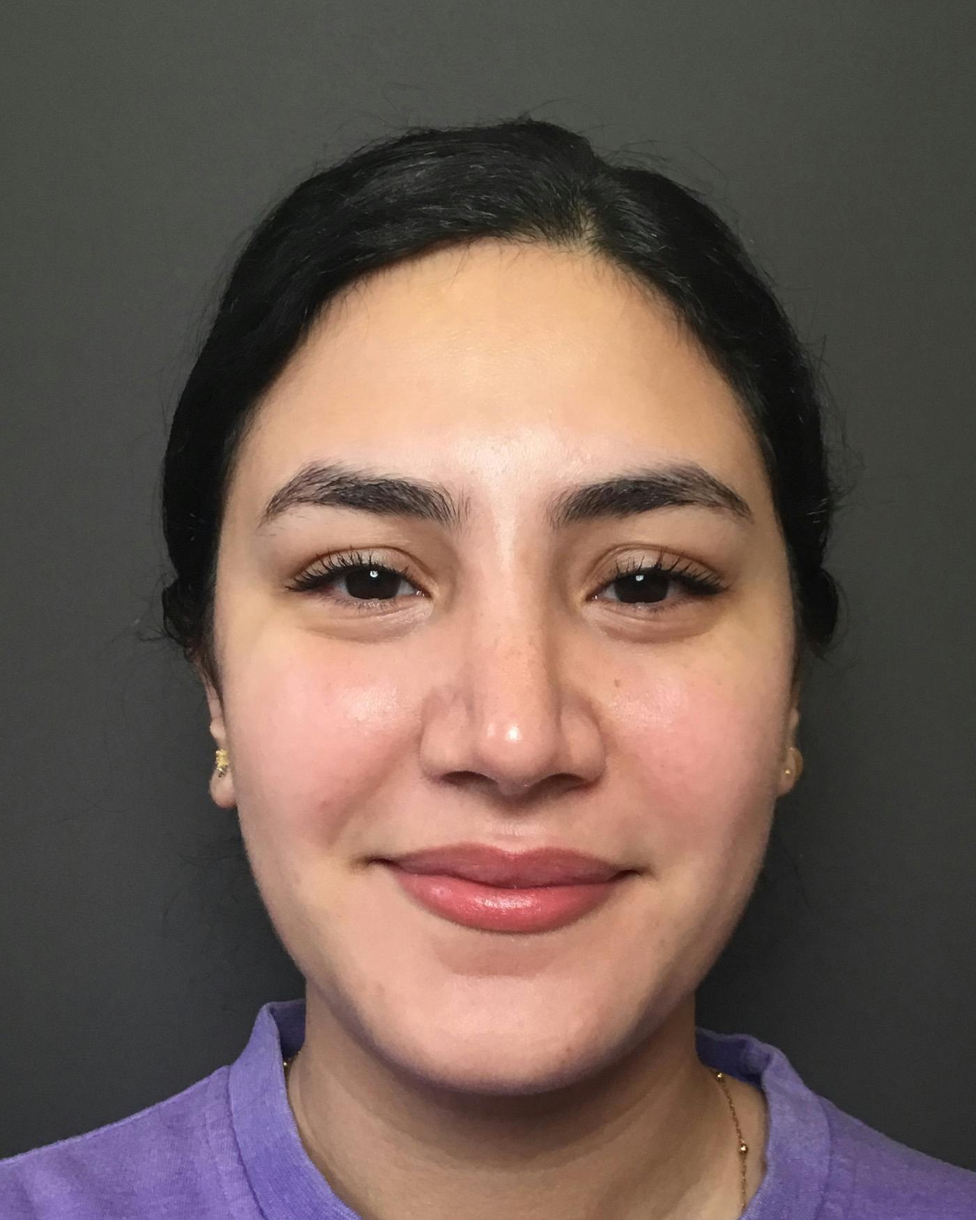 Rhinoplasty Before & After Gallery - Patient 403059 - Image 6