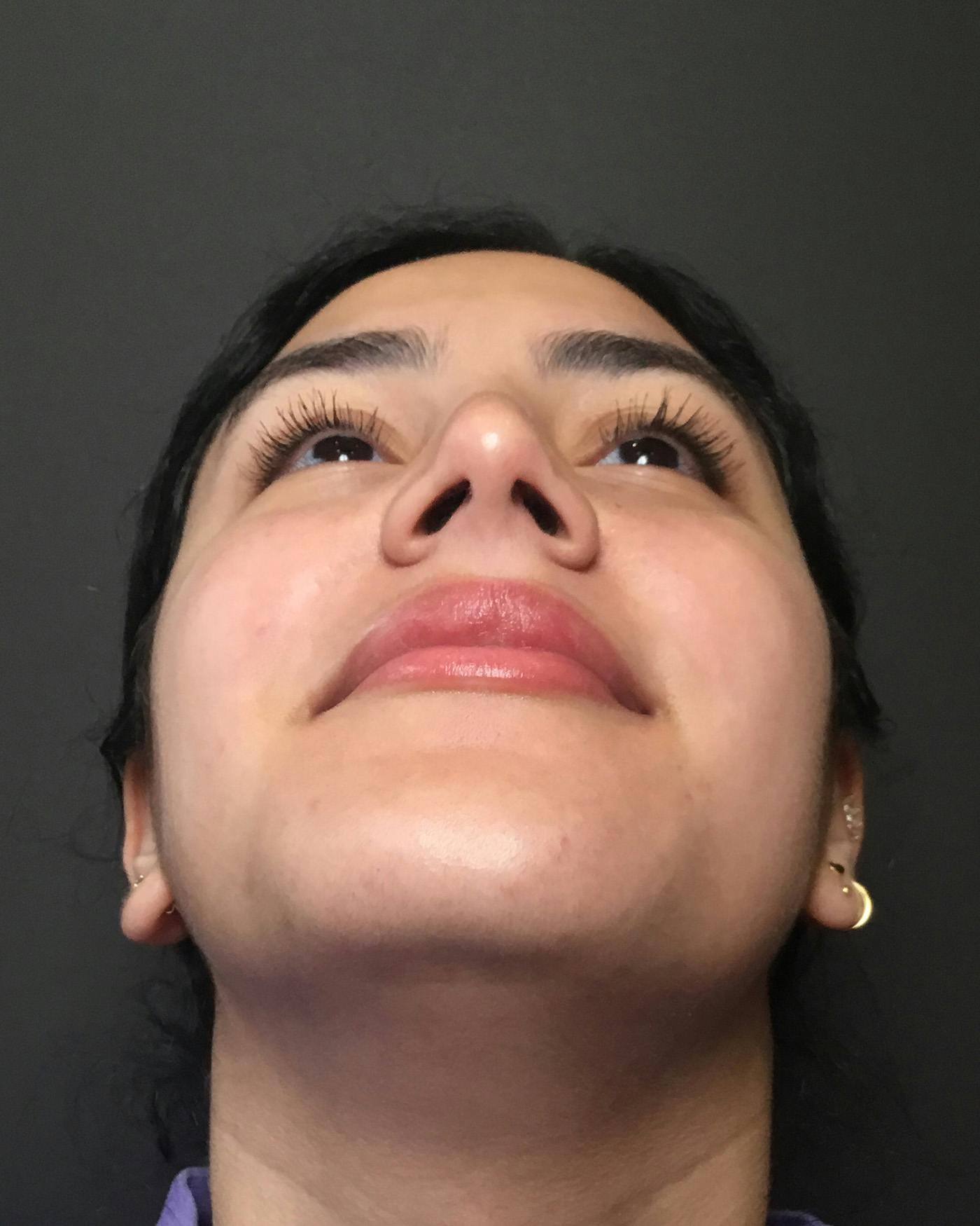 Rhinoplasty Before & After Gallery - Patient 403059 - Image 12