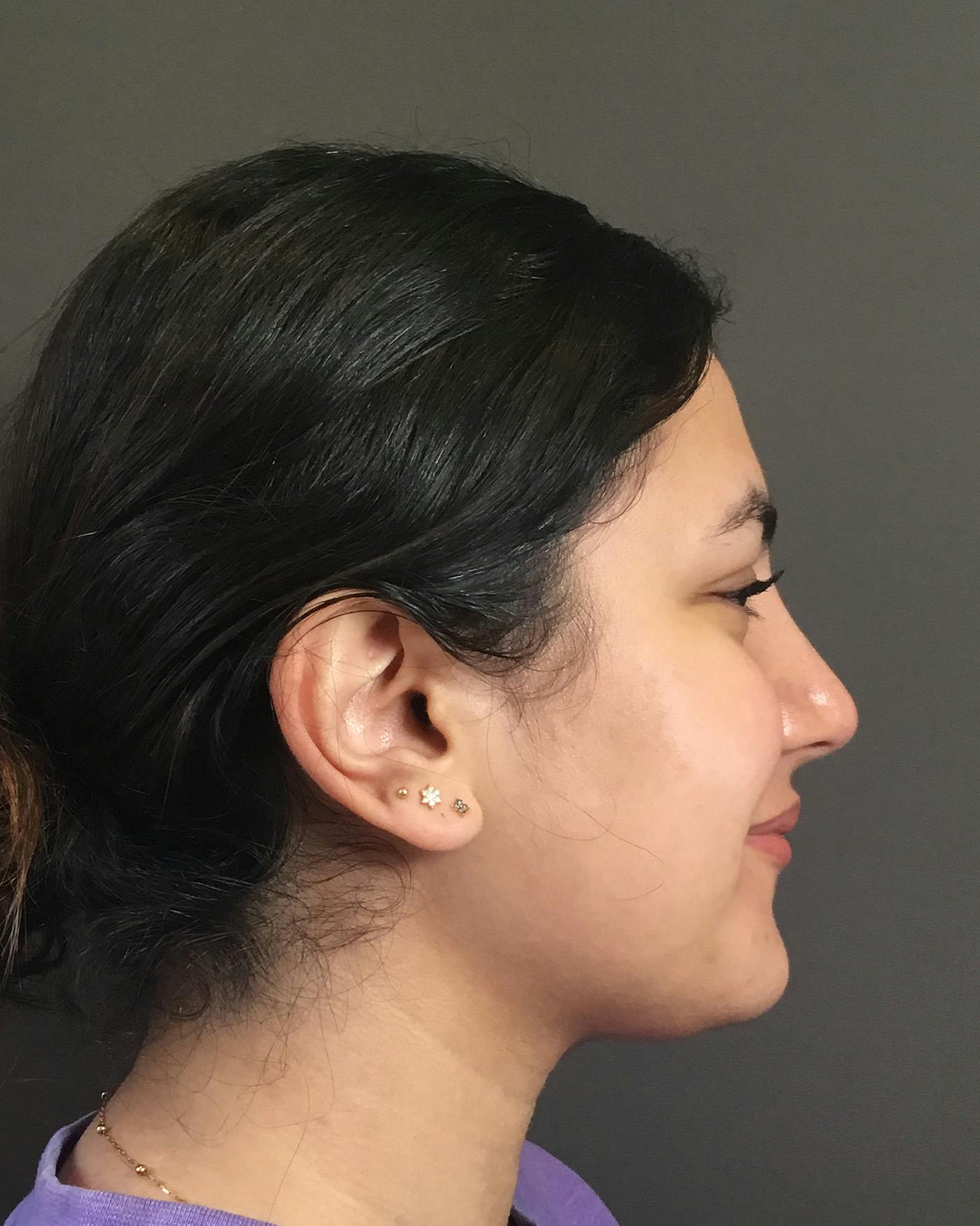Rhinoplasty Before & After Gallery - Patient 403059 - Image 2