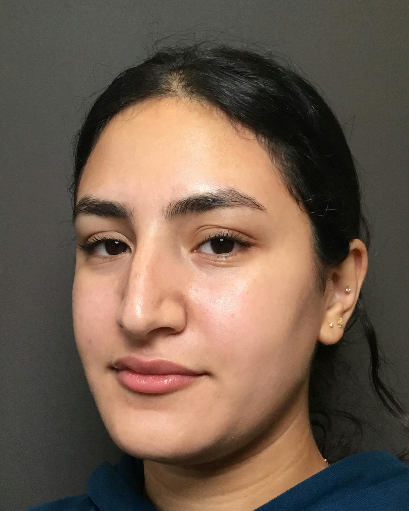 Rhinoplasty Before & After Gallery - Patient 403059 - Image 7