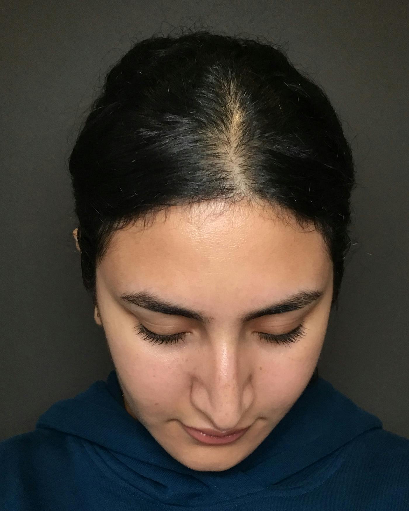 Rhinoplasty Before & After Gallery - Patient 403059 - Image 13