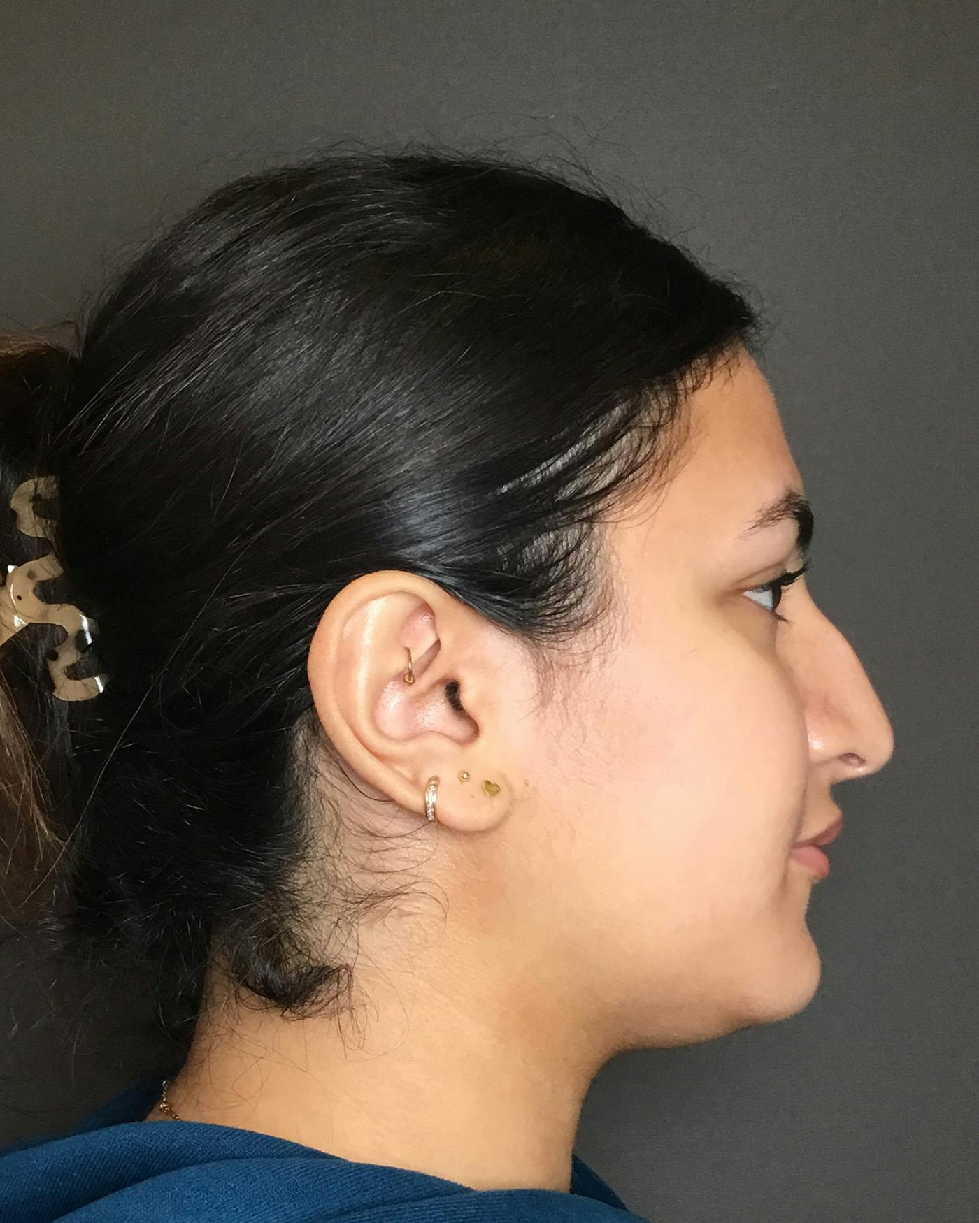 Rhinoplasty Before & After Gallery - Patient 403059 - Image 1