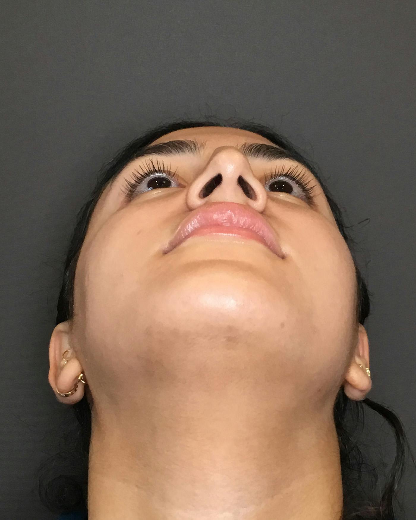 Rhinoplasty Before & After Gallery - Patient 403059 - Image 11