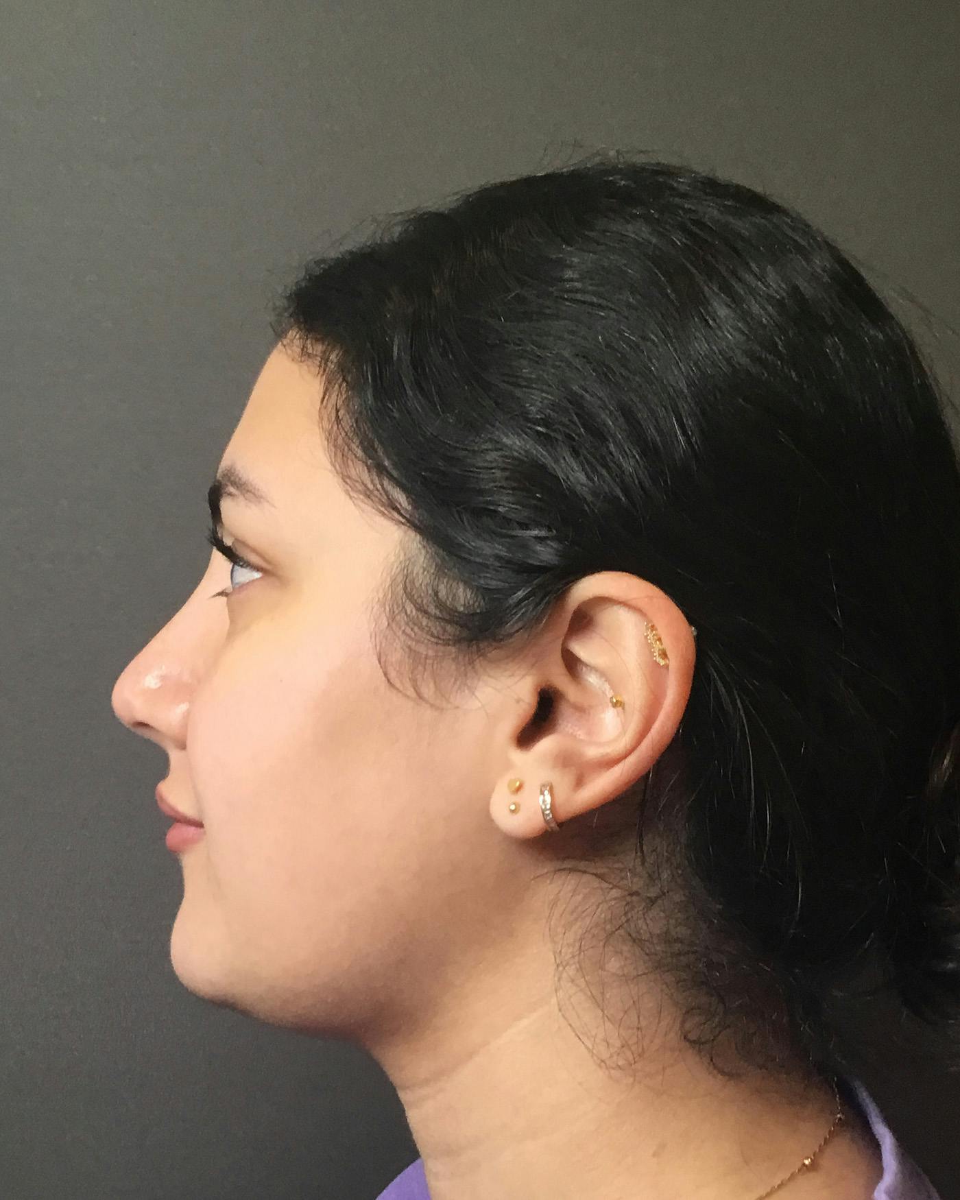 Rhinoplasty Before & After Gallery - Patient 403059 - Image 10