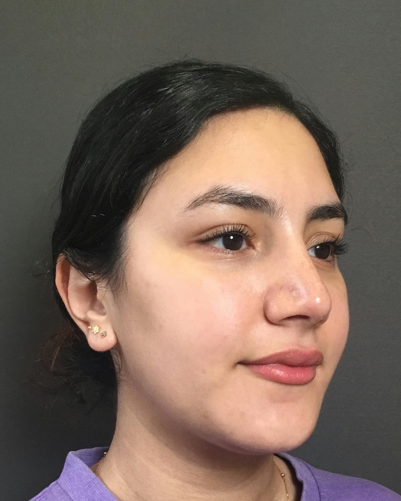 Rhinoplasty Before & After Gallery - Patient 403059 - Image 4